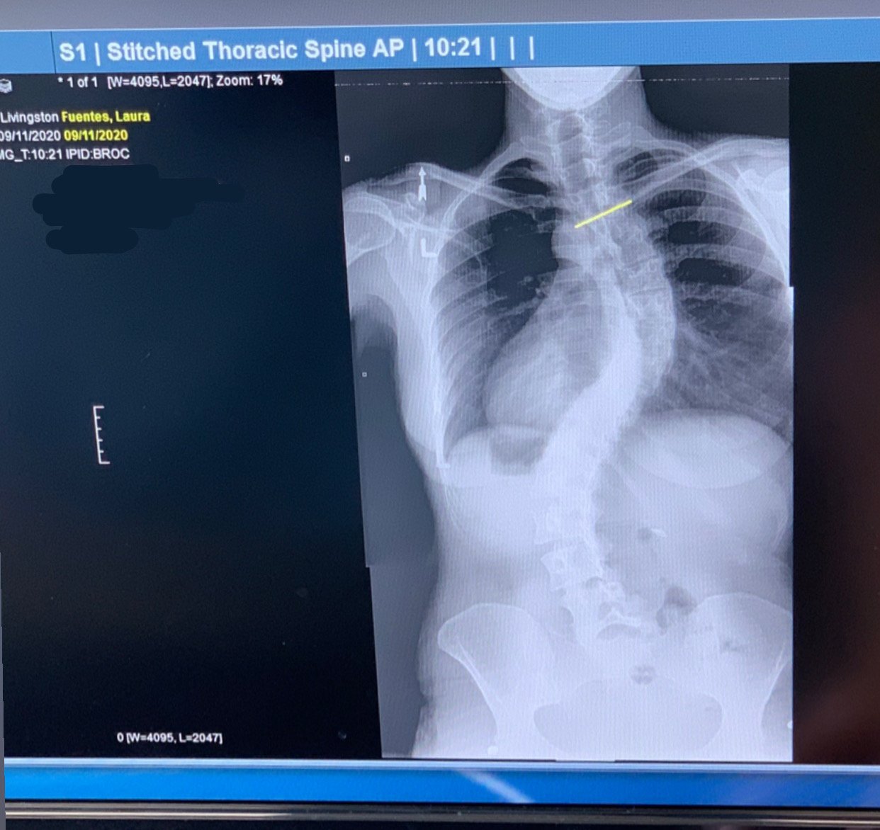 Laura Fuentes spine deformity x ray